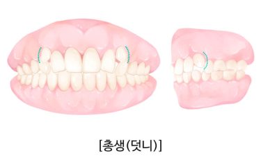 덧니 교정, 꼭 해야 할까? 미루면 안 되는 이유 | 안영민 원장 썸네일 이미지
