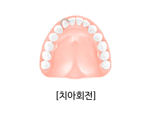 치아 한 개가 회전되어 배열이 틀어진 모습을 설명하는 일러스트
